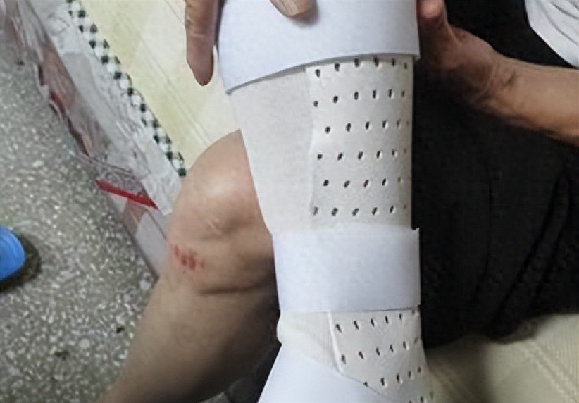 骨折就转运？骨折后多久能康复？骨科医生帮您解答